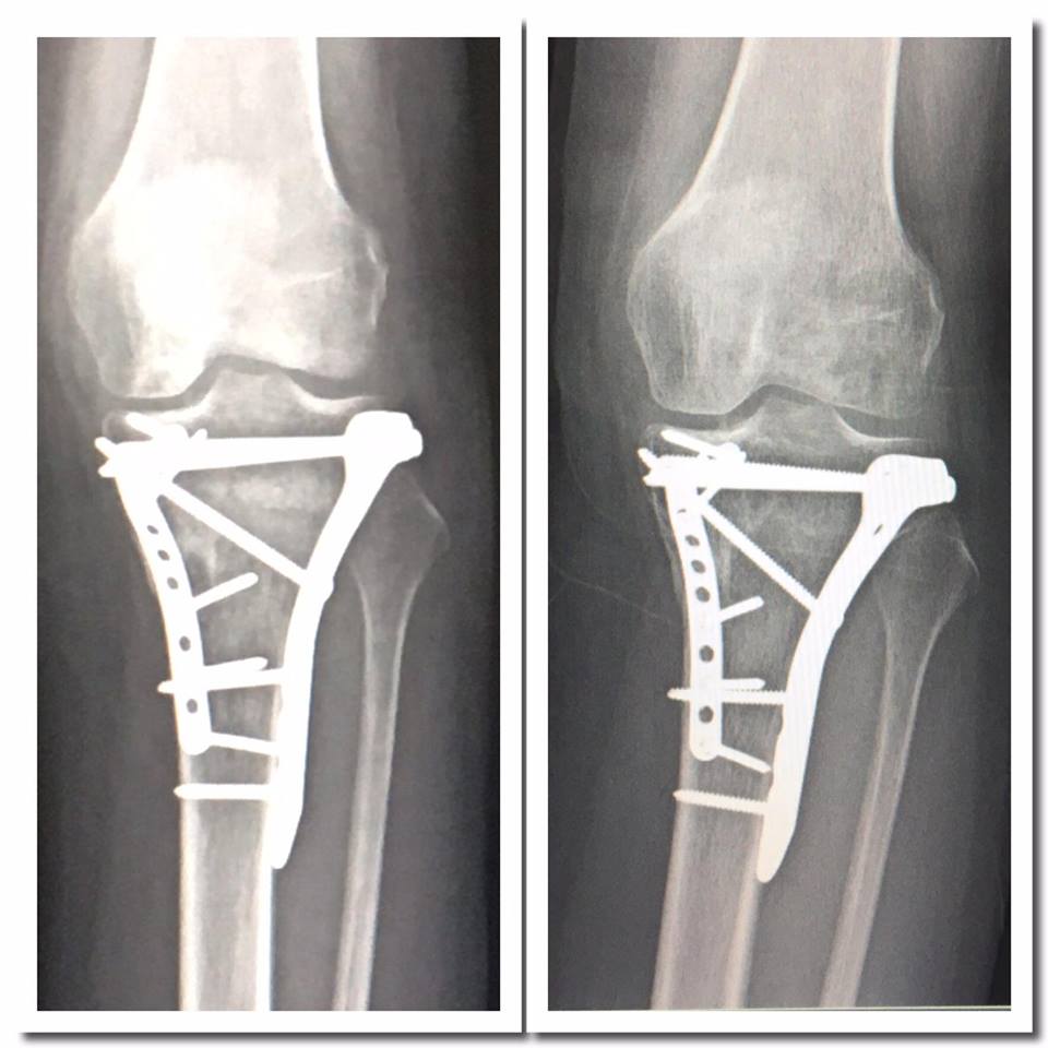 Tibial Plateau Fracture Recovery Part Four: Learning to Walk Again 51