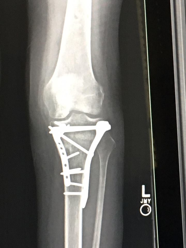 Tibial Plateau Fracture Recovery Blog