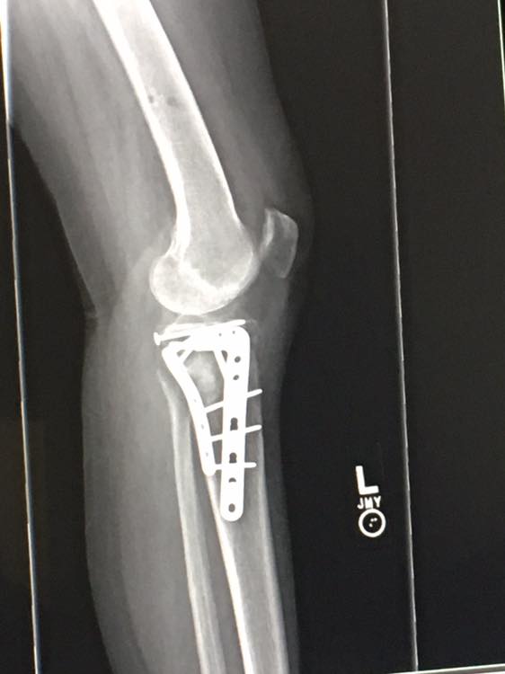 Broken Leg: If my tibial shaft fracture gets surgery, when can I